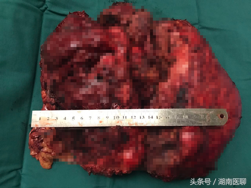 腰部有小肉球是不是有恶性瘤,女三十三岁腰部长了瘤是啥病