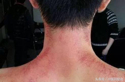 清痰止咳刮痧方法,刮痧治肺寒咳嗽有效吗