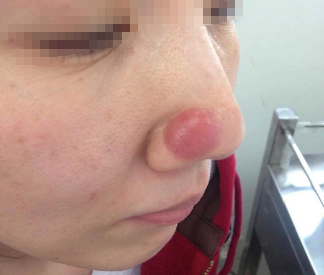鼻子上长了个冒白头的痘痘,鼻子长了一个大红痘