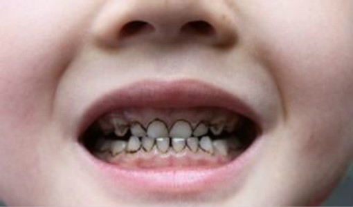 孩子刷牙了可是牙还是黄的,宝宝不爱刷牙怎么预防龋齿