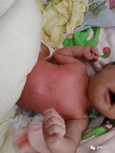 孩子湿疹反复有必要忌口吗,宝宝经常湿疹吃什么维生素