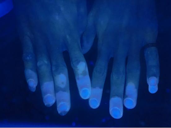 手部的白斑如何复色,治疗手部白斑最有效办法