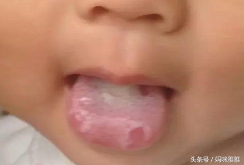 宝宝吃多了多久才会积食发烧,小月龄宝宝积食严重怎么处理