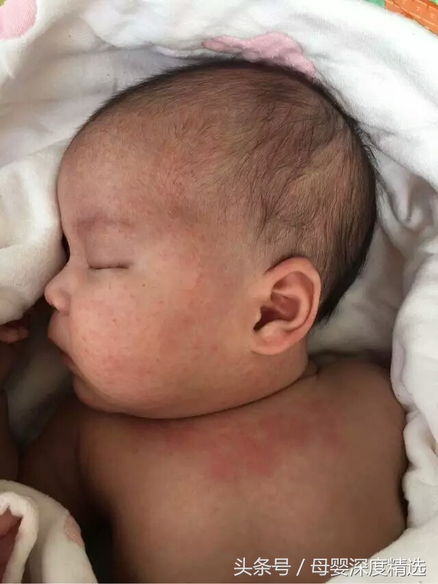 婴儿面部湿疹怎么护理效果最好,宝宝湿疹流脓结痂的部分怎么护理