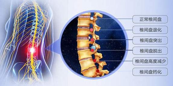 70岁老人腰椎间盘突出适合手术吗,腰椎间盘突出4mm躺几天能自愈吗