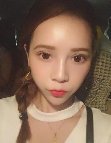 韩式三点定位恢复图片,韩式三点双眼皮恢复一个月图片