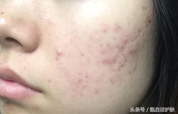 如何祛除痘印男性,如何祛除痘印男生