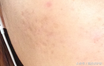 痘坑痘疤做什么手术才能去除,如何去除痘疤痘印痘坑