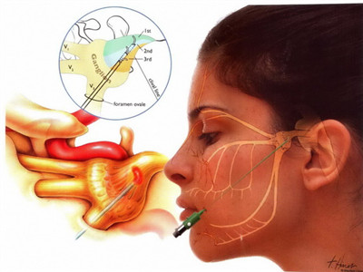 牙疼放了杀神经药还疼怎么缓解,牙痛神经痛可以根管治疗吗