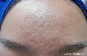 痘坑痘疤做什么手术才能去除,如何去除痘疤痘印痘坑