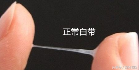 已婚女性的正常白带是怎样的,女性白带多科普