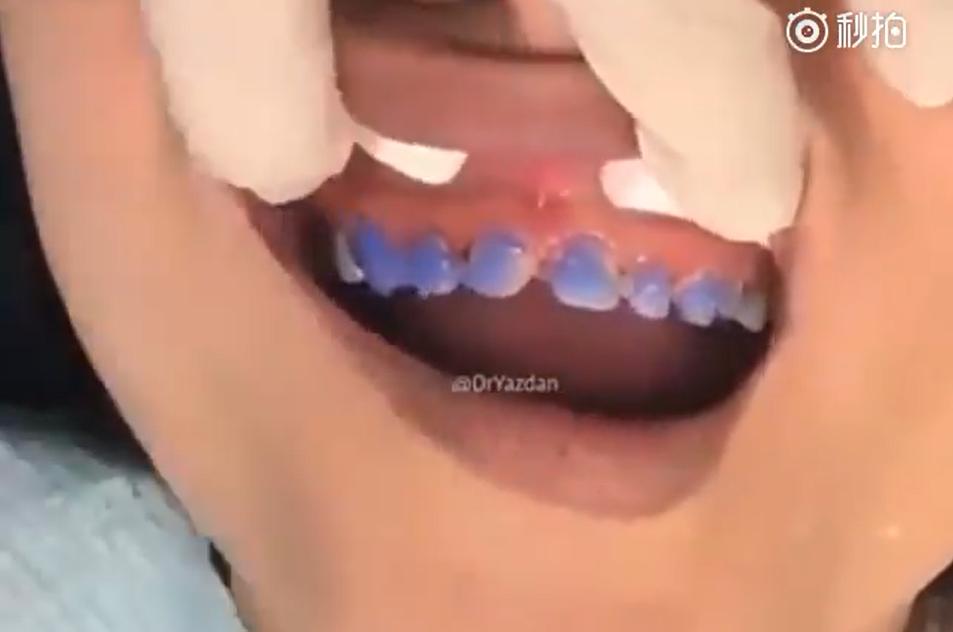 美容冠的副作用,美容冠真实缺点