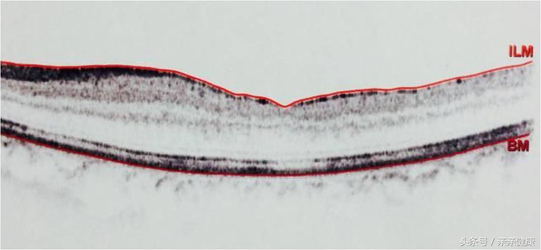 黄斑裂孔怎么治疗,黄斑出血和黄斑裂孔的区别