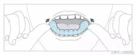 隐适美隐形矫正摘戴、保养关注事项全攻略