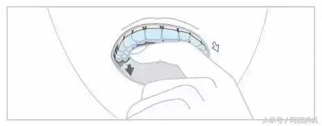 隐适美隐形矫正摘戴、保养关注事项全攻略