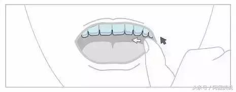 隐适美隐形矫正摘戴、保养关注事项全攻略