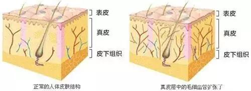 红血丝泛红怎么改善,红血丝肌肤怎么治