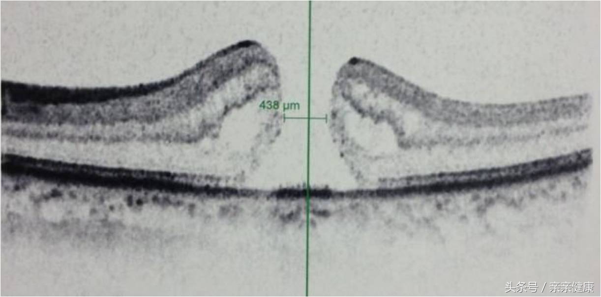 黄斑裂孔怎么治疗,黄斑出血和黄斑裂孔的区别