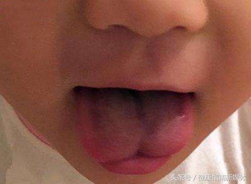 小孩舌头能伸出来是舌系带短吗,舌系带短孩子平翘舌不分怎么办