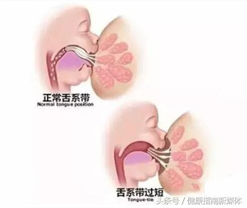 小孩舌头能伸出来是舌系带短吗,舌系带短孩子平翘舌不分怎么办