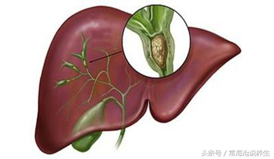 胆囊息肉中医院治疗能消失吗,多发性胆囊息肉怎么治疗比较好