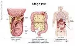 得了直肠癌怎么知道,你了解结直肠癌吗