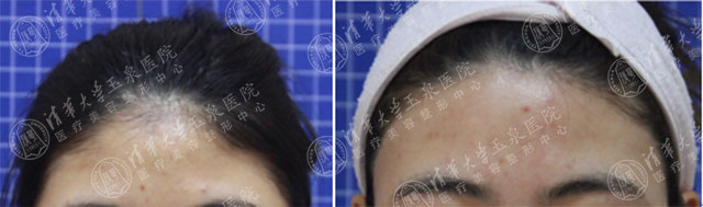 专家讲激光脱毛,激光祛斑现身说法