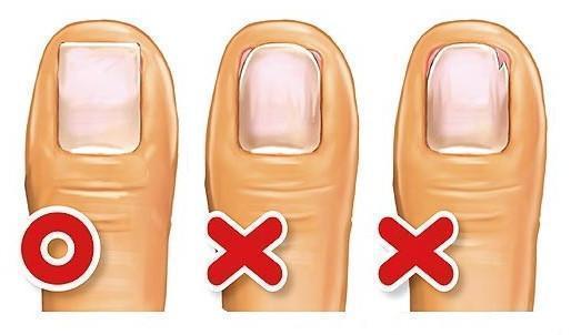 脚趾甲里又长了一层脚趾甲怎么办,脚趾甲往肉里长有啥好办法