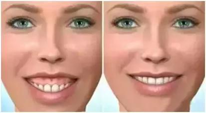 牙周病的治疗的4个程序,牙周病怎么治疗最有效好得快