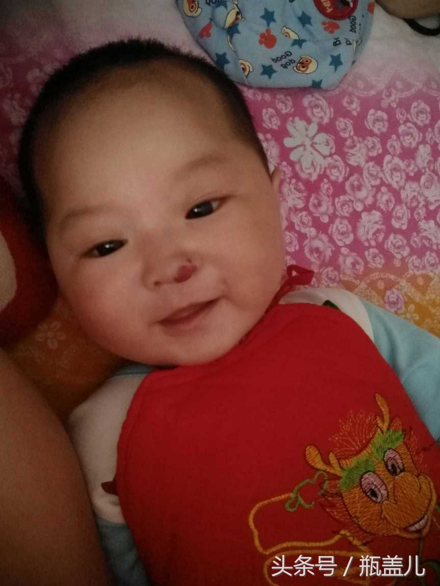 宝宝鼻子上的血管瘤怎么办,宝宝鼻子上长血管瘤怎么治