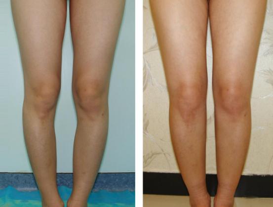 王明利自体脂肪丰臀怎么样,穿什么可以显腿瘦