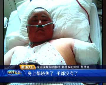 干农活受伤了,农村小伙干农活摔伤了手