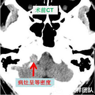 舌头突然不利索,舌头突然间不好使一会就好了