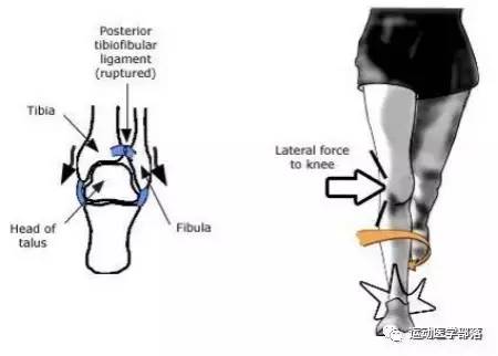 崴脚反复肿是什么原因,反复的脚崴怎么治疗