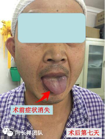 舌头突然不利索,舌头突然间不好使一会就好了