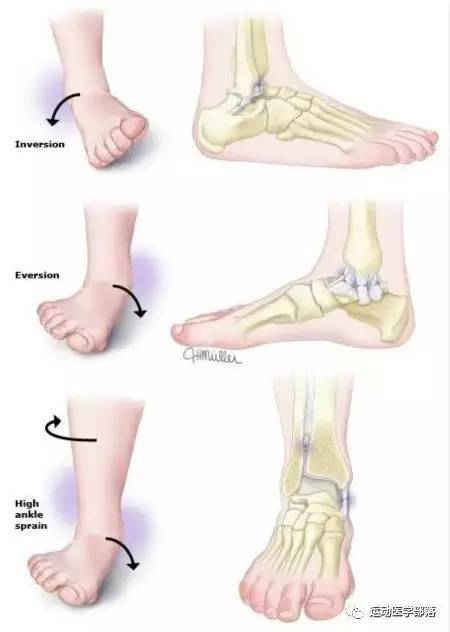 崴脚反复肿是什么原因,反复的脚崴怎么治疗
