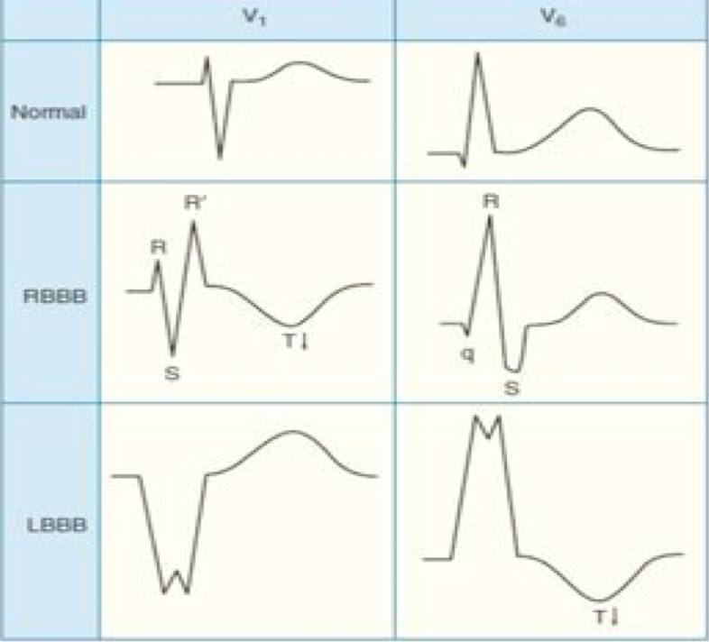 完全性左束支传导阻滞可以治愈吗,完全性左束支传导阻滞能否治愈