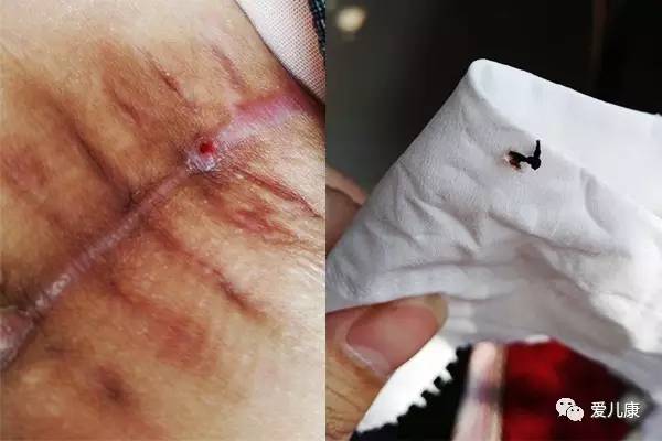 剖腹产后发现疤痕有一个小线头,剖腹产后刀疤上还有线头