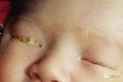 剖腹产后发现疤痕有一个小线头,剖腹产后刀疤上还有线头