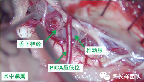 舌头突然不利索,舌头突然间不好使一会就好了