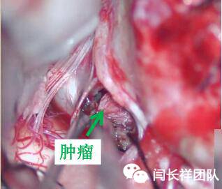 舌头突然不利索,舌头突然间不好使一会就好了