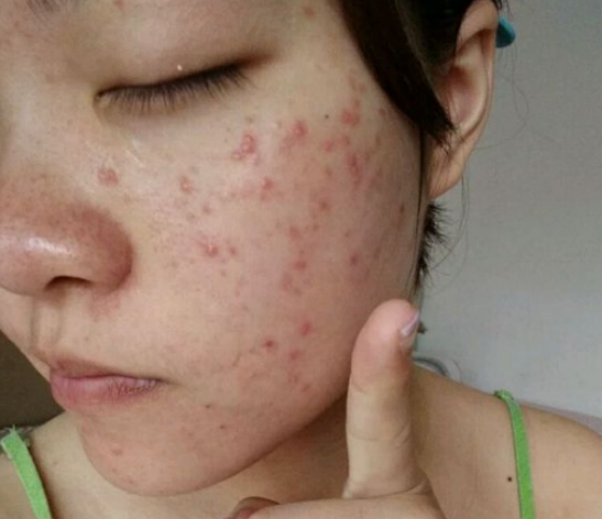 青春痘反复长不停如何正确祛痘,13岁女孩长青春痘怎么祛痘