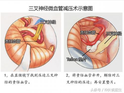 三叉神经痛的发病原因及治疗方法,三叉神经痛有哪些症状怎样治疗