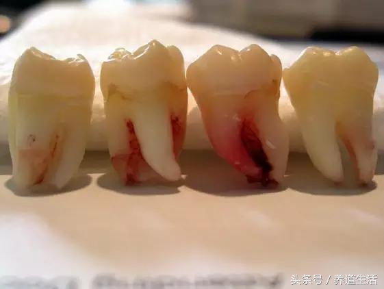 拔智齿打麻药关注左大脑有点跳动,治牙经常打麻药对大脑有损伤吗