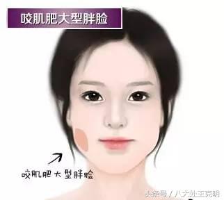 肉毒素咬肌可以完全消除吗,肉毒素能改善咬肌肥大吗