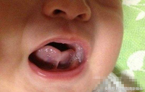 小孩舌头能伸出来是舌系带短吗,舌系带短孩子平翘舌不分怎么办