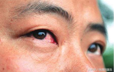 结膜炎白眼球为什么越来越红,白眼球充血跟肝有关系吗