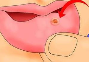 口腔溃疡寻医问药,求医口腔溃疡