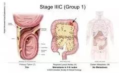 得了直肠癌怎么知道,你了解结直肠癌吗