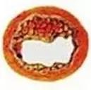 血管衰老怎么补充营养,血管衰老保健案例